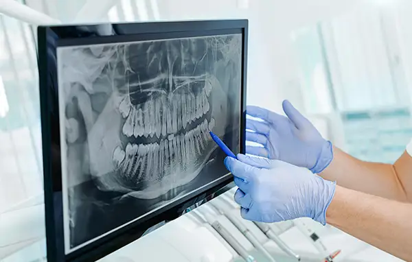 Close-up of a dental X-ray displayed on a computer monitor, with a dentist pointing to the image for analysis.